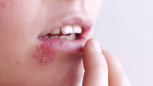 ویروس تبخال می‌تواند باعث افزایش ریسک ابتلا به زوال عقل شود