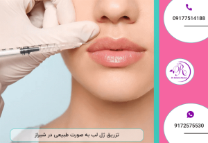 ژل لب در شیراز 12 ژل لب در شیراز