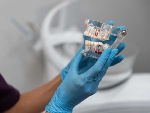 ایمپلنت دیجیتال