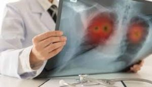 شانس بقا در خط اول درمان سرطان ریه؛ ترکیب داروی Tagrissoو شیمی‌درمانی جان تازه‌ای به بیماران می‌دهد