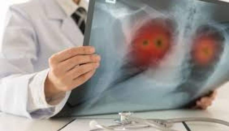 شانس بقا در خط اول درمان سرطان ریه؛ ترکیب داروی Tagrissoو شیمی‌درمانی جان تازه‌ای به بیماران می‌دهد